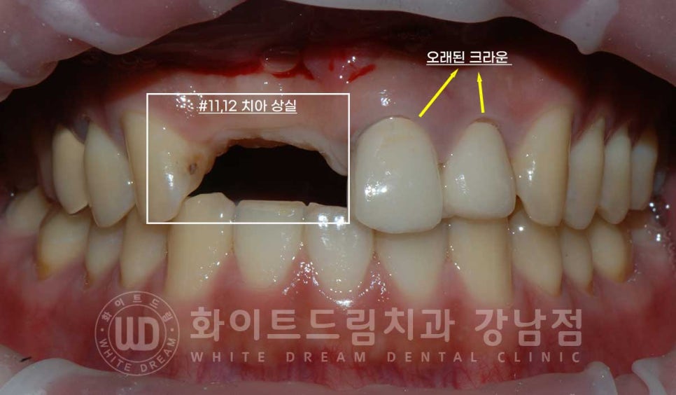 앞니 임플란트 사례 "예전에 심은 임플란트를 뺐어요. 재수술 가능할까요?" 관련 이미지 5