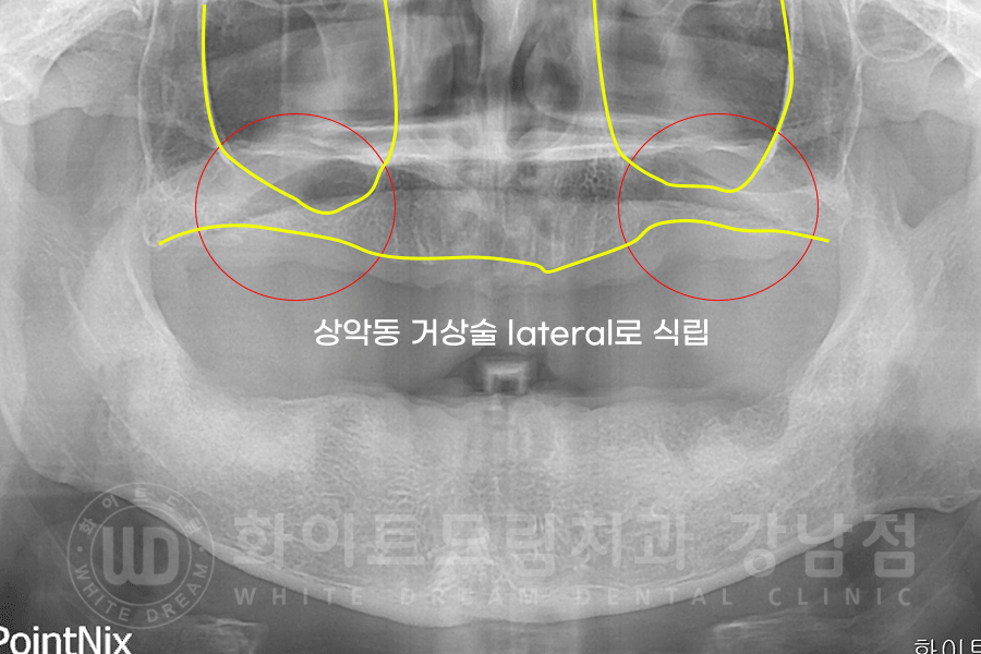 강남역 전체임플란트 치과 "치아가 심하게 흔들려요." 심한 치주염 임플란트 치료 관련 이미지 8