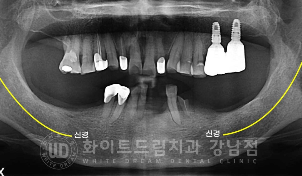 잇몸뼈가 없다는 게 무슨 말일까? "틀니를 오래 사용해서 잇몸뼈가 없대요" 임플란트 잘하는 강남치과 관련 이미지 8