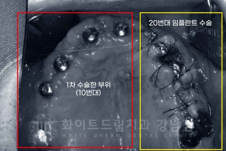 전체임플란트 치료기간 / "전체 임플란트 6개월 완성" (feat. 부분 틀니 10년 사용) 관련 이미지 17