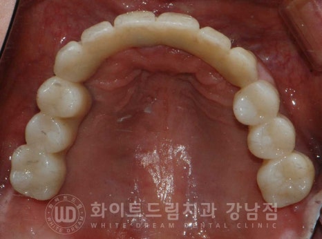 치주염 전체임플란트 치료 사례 / 치아를 흔들리게 만드는 치주염이란? 관련 이미지 13