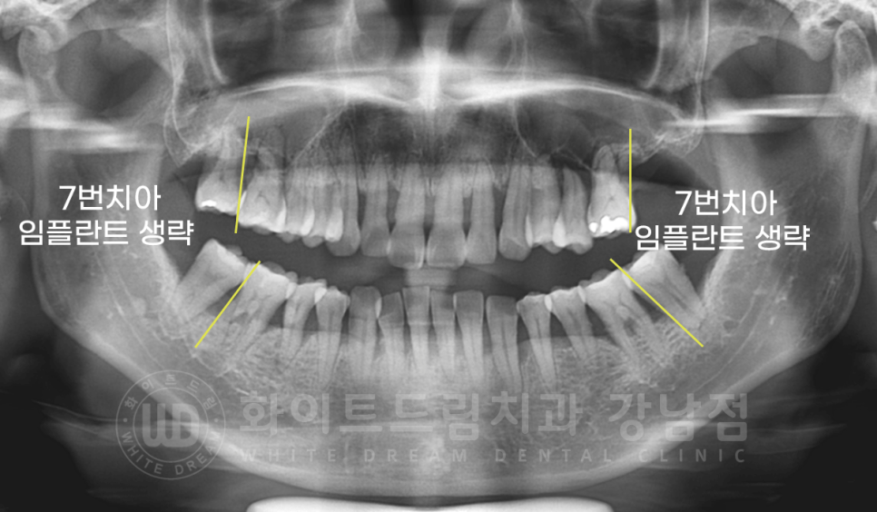 서초동 치과 추천 / "임플란트 개수를 줄이는 식립 방법은?" 강남 화이트드림치과 임플란트 관련 이미지 7