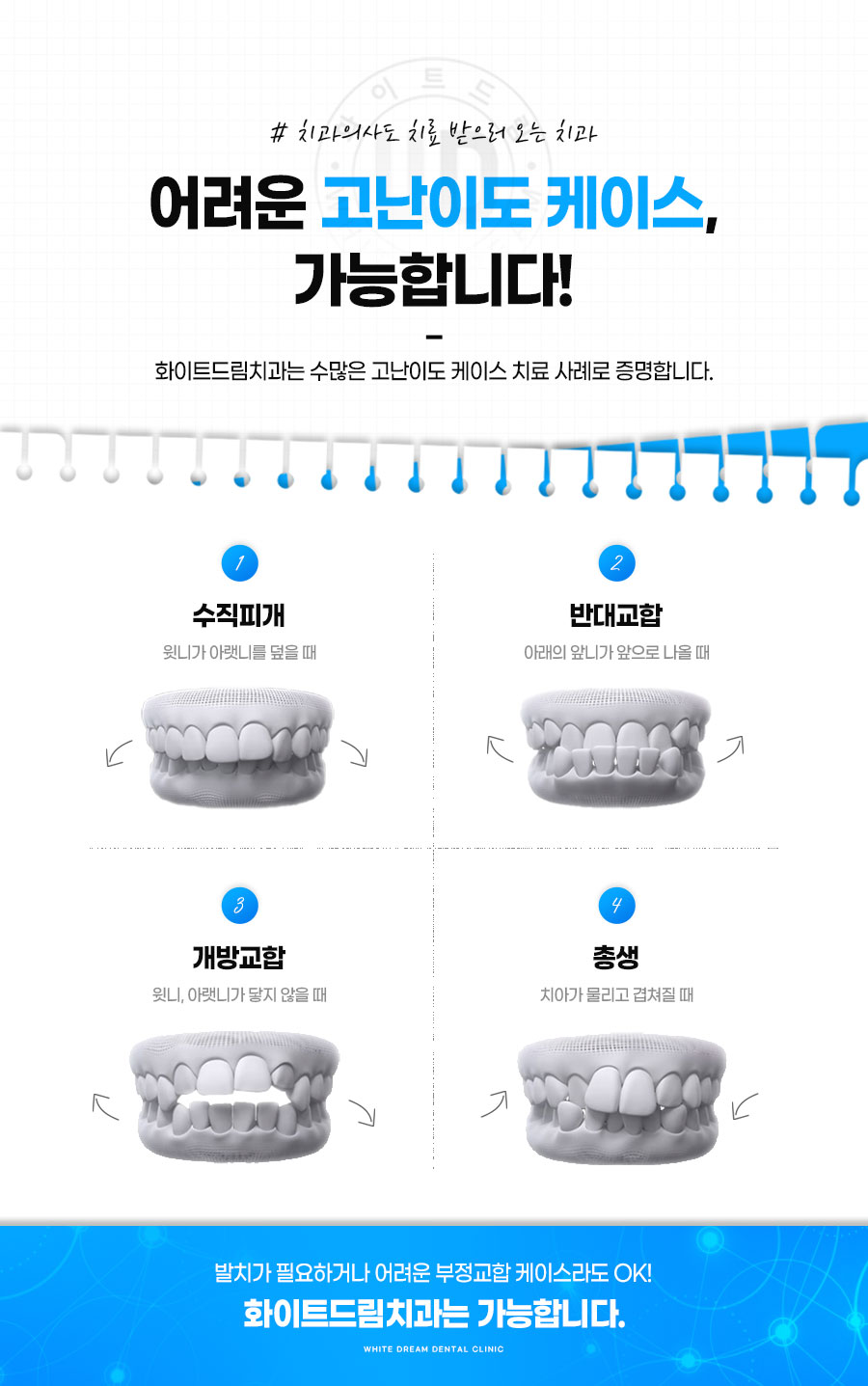 치아교정, 꼭 해야 한다면 미리 알아두자. 관련 이미지 4