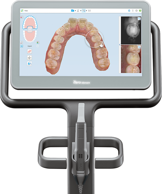 라미네이트 치료에 대해 알아보면? 관련 이미지 6
