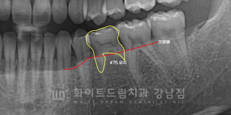 영구치 결손, "유치가 흔들려요." 성인 잔존 유치 발치 후 바로 임플란트 식립! 관련 이미지 4