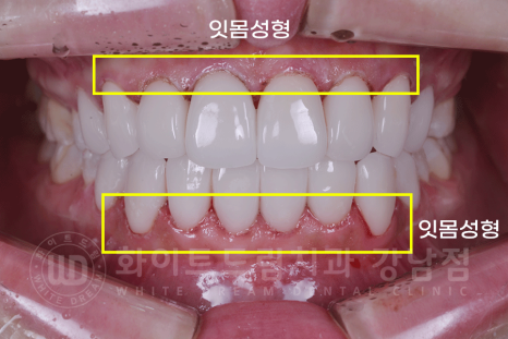 강남역 원데이 라미네이트 "유튜브 촬영하는데 치아가 신경 쓰여요" #강남화이트드림치과 관련 이미지 13