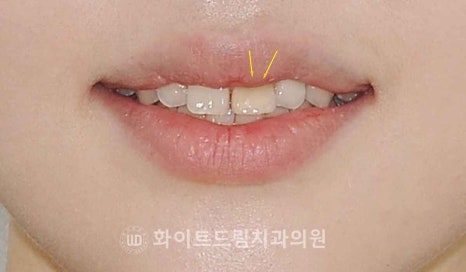 강남역앞니치과 / "신경치료한 치아가 누렇게 변했어요." 신경치료 후 변색된 치아, 어떻게 치료하나요? 관련 이미지 13