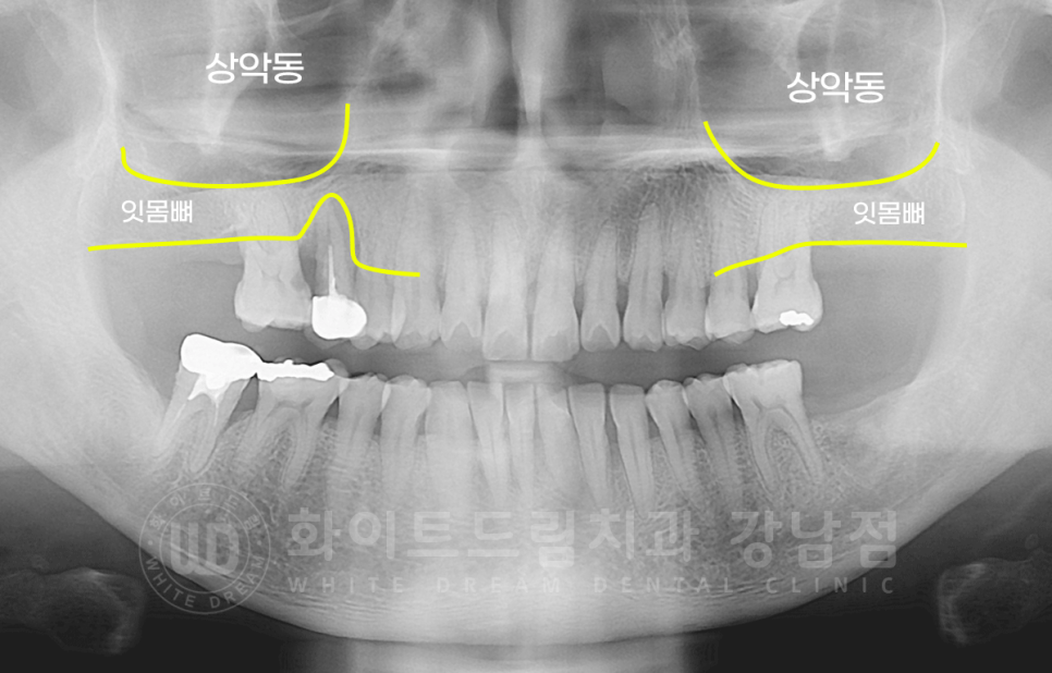 서초동 어금니 임플란트 / 강남역 화이트드림치과 : 상악동 거상술 (crestal approch) 관련 이미지 8
