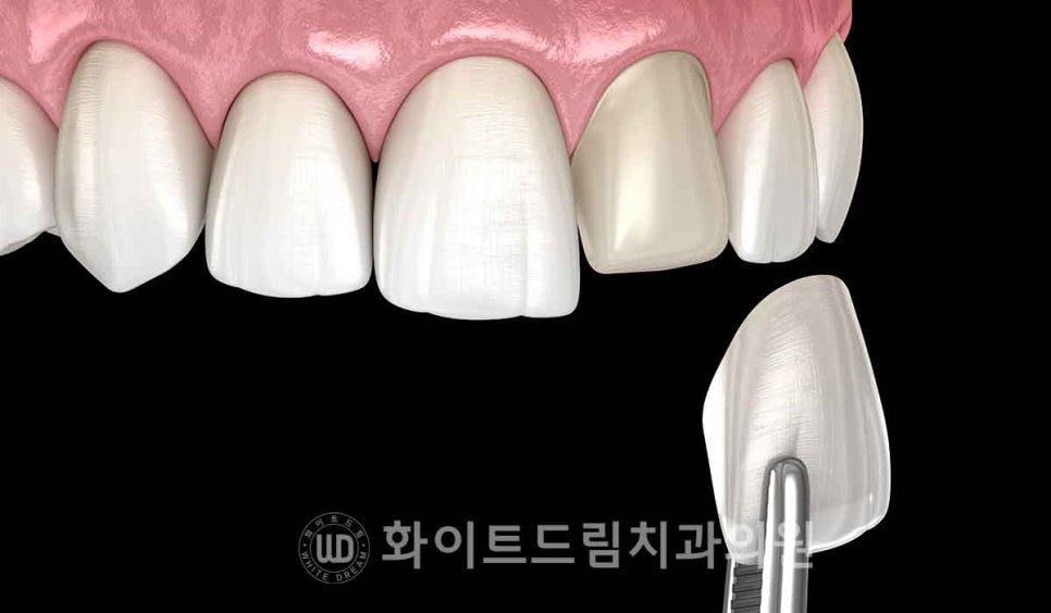 뱅뱅사거리치과 "라미네이트가 마음에 들지 않아요. 하얗고 균일한 치아를 갖고 싶어요." 강남역 화이트드림치과 관련 이미지 14