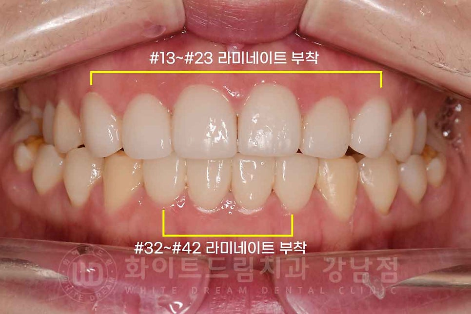 법랑질형성부전증, 라미네이트로 개선해요! / 강남역 라미네이트 치과 관련 이미지 10