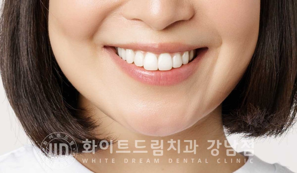 앞니 레진변색 "너무 지저분해 보여요." 라미네이트로 깔끔하게 교체한 치료 사례 관련 이미지 9