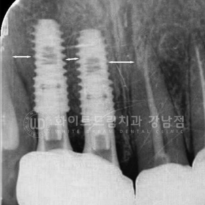 앞니 임플란트 사례 "예전에 심은 임플란트를 뺐어요. 재수술 가능할까요?" 관련 이미지 9