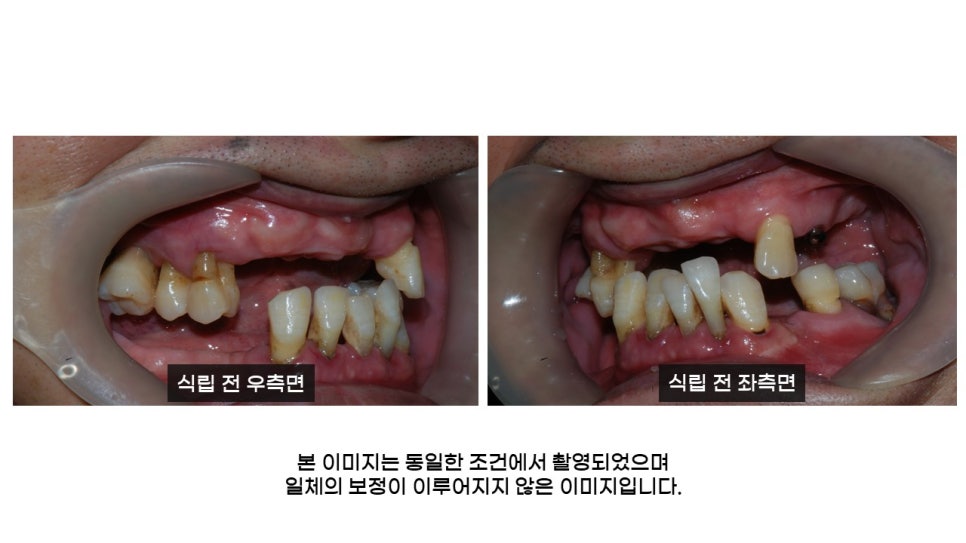 40대임플란트식립후기 및 어금니임플란트 가격, 종류 알아보기 위해 관련 이미지 2