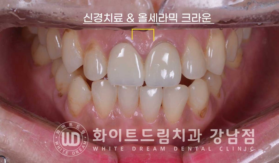 치경부착색 치료 / 라미네이트 vs 올세라믹 치아 삭제량 비교 (Feat. 라미네이트 후 치아미백 가능한가요?) 관련 이미지 6