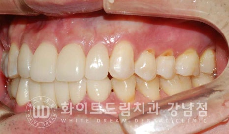 강남역 결손치 "앞니 두 개가 없고, 벌어졌어요" 결손치 치료 방법 관련 이미지 9