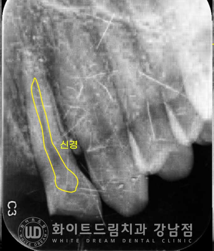앞니 빠짐 임플란트 / 사고로 인한 앞니 탈구. 앞니 임플란트 치료는? 관련 이미지 8