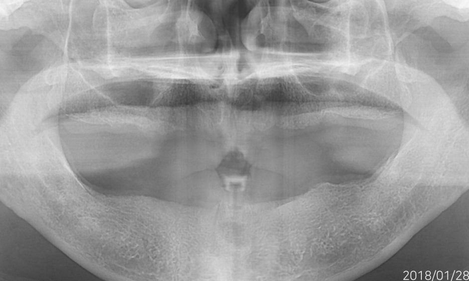 임플란트 하기 전 알아보아야 할 것. 관련 이미지 15