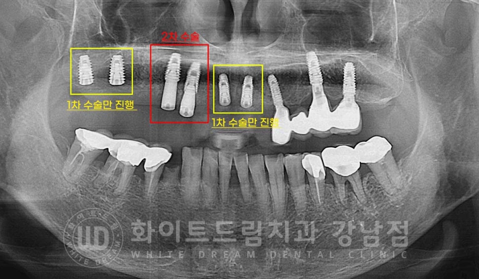 임플란트 1차 수술, 2차 수술이란 무엇일까? (+ 상악 전체 임플란트 치료 기간) 관련 이미지 8