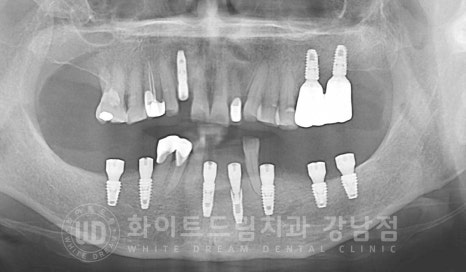 잇몸뼈가 없다는 게 무슨 말일까? "틀니를 오래 사용해서 잇몸뼈가 없대요" 임플란트 잘하는 강남치과 관련 이미지 10