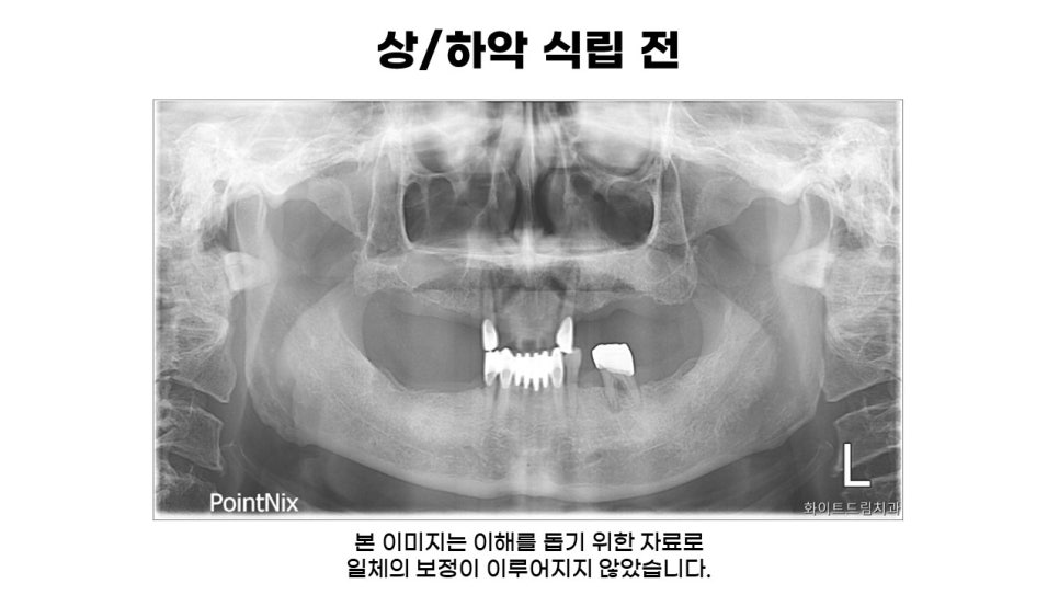 60대 전악임플란트후기 및 치료기간 관련 이미지 3