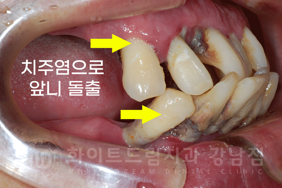 강남역 전체임플란트 치과 "치아가 심하게 흔들려요." 심한 치주염 임플란트 치료 관련 이미지 3