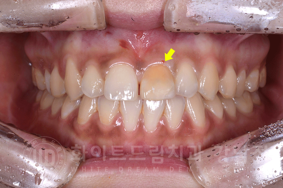 강남역 주변 치과 "10년 된 앞니가 변색됐어요" 앞니 심미 치료 관련 이미지 2