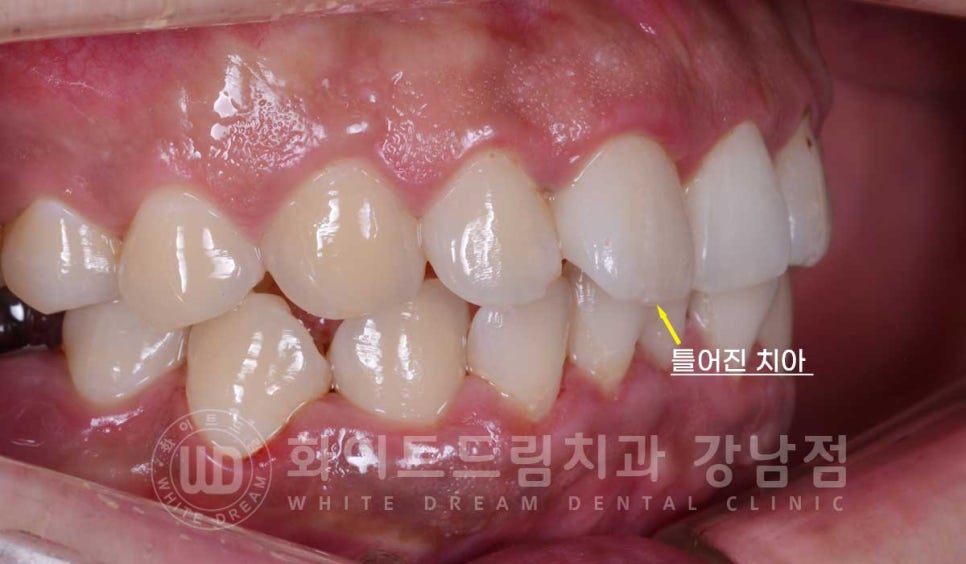 틀어진 치아 라미네이트, 틀어지고 색이 다른 앞니가 고민이에요. 관련 이미지 9