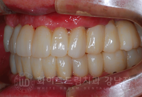 강남역 전체임플란트 치과 "치아가 심하게 흔들려요." 심한 치주염 임플란트 치료 관련 이미지 22