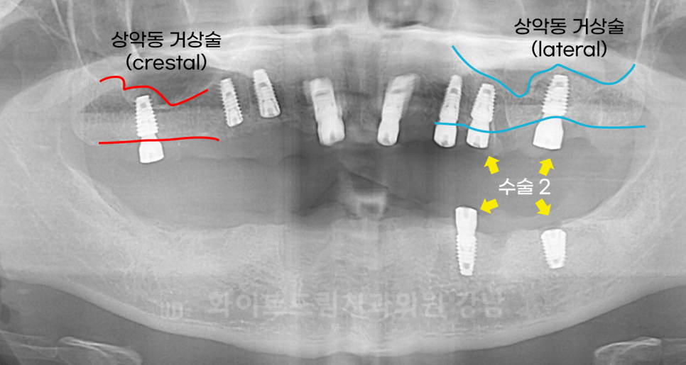 강남역 임플란트 치과 "틀니가 안 맞아서 불편해요" 틀니 → 전체 임플란트로! 관련 이미지 12