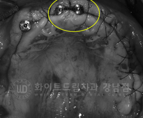 강남역 전체임플란트 치과 "치아가 심하게 흔들려요." 심한 치주염 임플란트 치료 관련 이미지 11