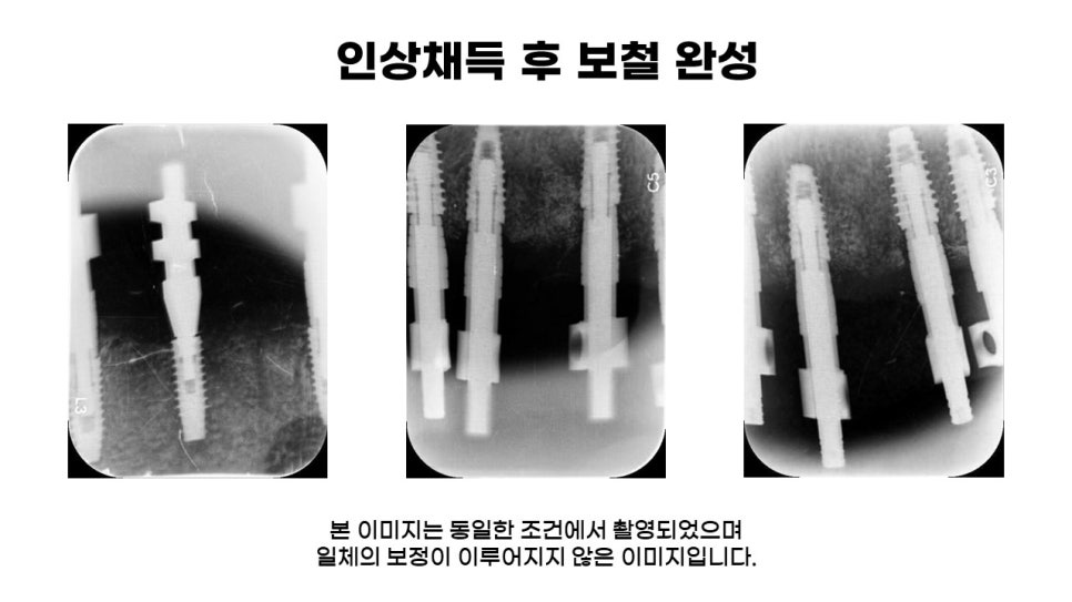 어금니임플란트 수복 및 당뇨환자임플란트 가격, 종류, 통증 관련 이미지 10