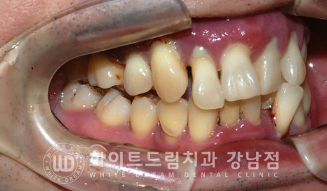 40대 전체임플란트 / 디지털스캔바디를 이용한 전체 임플란트 치료 사례 (Feat. 치주염) 관련 이미지 23