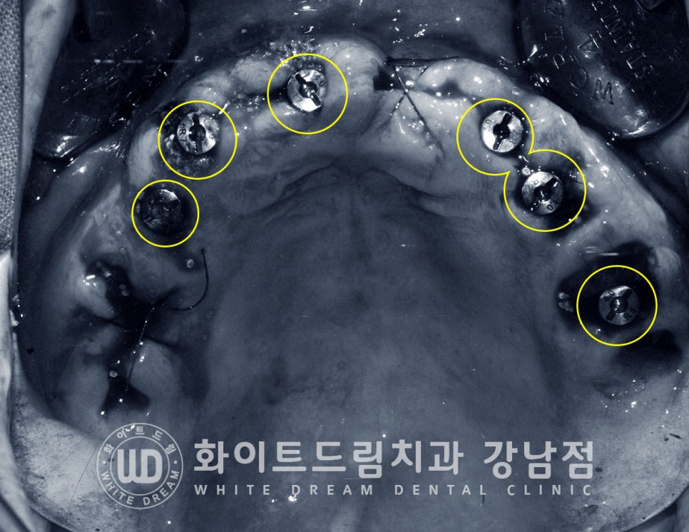 상악 풀케이스임플란트 사례 / "지인 추천으로 인천에서 왔어요." 관련 이미지 10