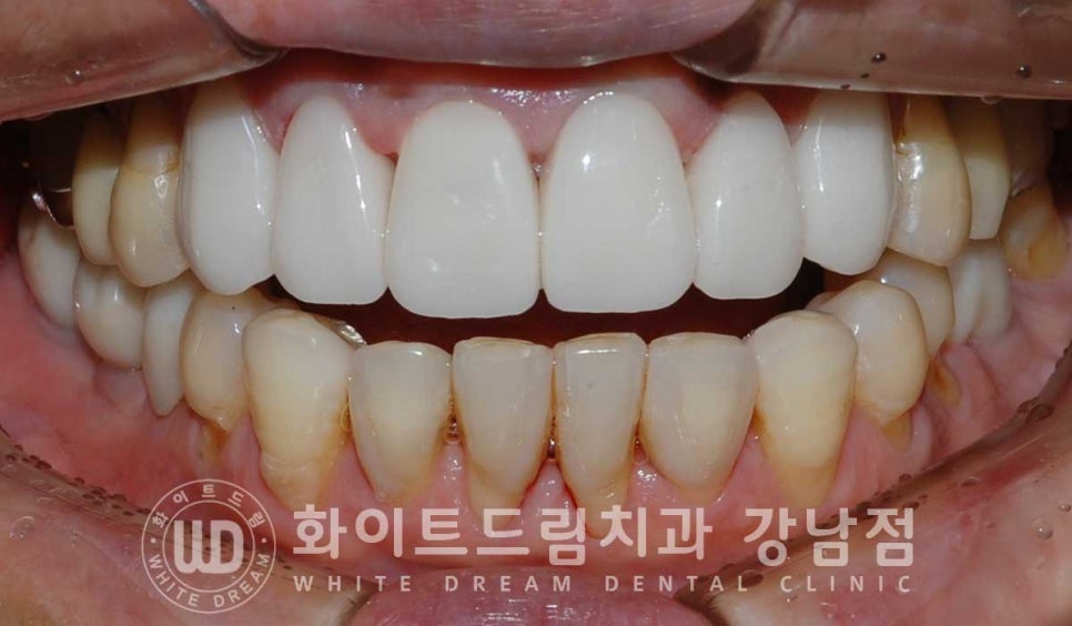 앞니라미네이트 교체 "5년 전에 한 라미네이트가 뻗쳐 보여요" 예쁘게 치료할 수 있나요? 관련 이미지 8