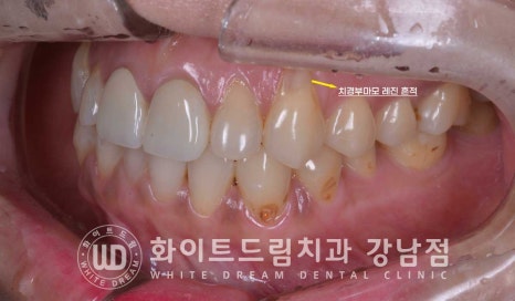 치경부착색 치료 / 라미네이트 vs 올세라믹 치아 삭제량 비교 (Feat. 라미네이트 후 치아미백 가능한가요?) 관련 이미지 3