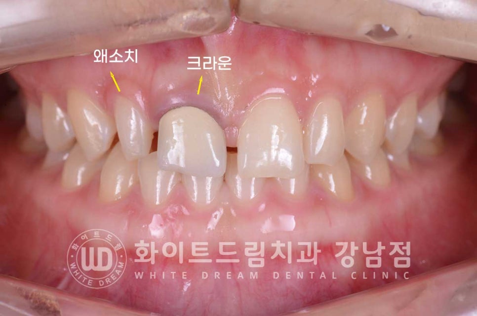 벌어진 앞니라미네이트 / "왜소치로 치아가 벌어졌어요" 치료 사례 관련 이미지 3