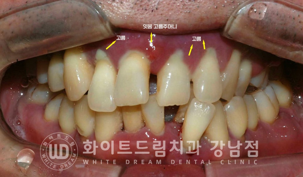 40대 전체임플란트 / 디지털스캔바디를 이용한 전체 임플란트 치료 사례 (Feat. 치주염) 관련 이미지 5