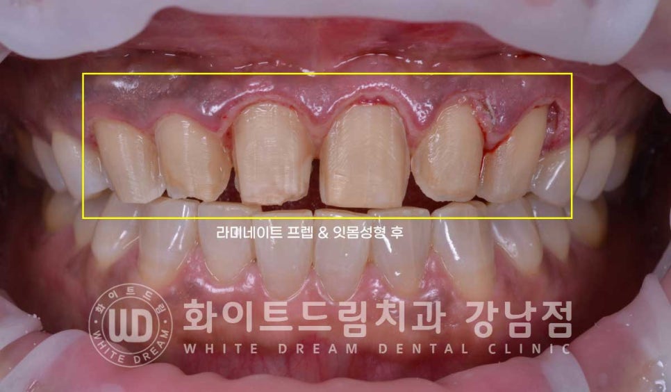 깨진앞니 라미네이트 / 깨지고 누렇게 변한 앞니는? 원데이 라미네이트 치료 사례 관련 이미지 10