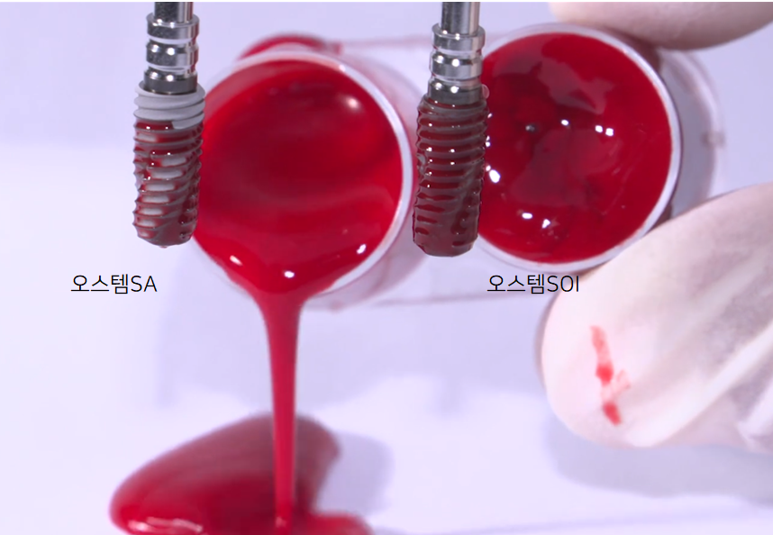 오스템SOI임플란트는 왜 좋을까? 관련 이미지 2