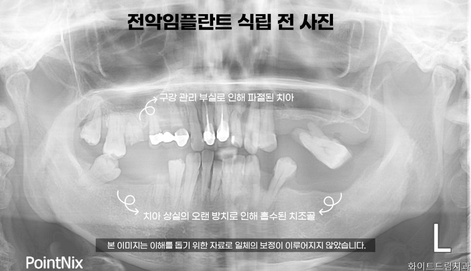 40대 전악 임플란트 식립 증례 관련 이미지 2