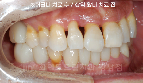 서초동 치과 추천 / "임플란트 개수를 줄이는 식립 방법은?" 강남 화이트드림치과 임플란트 관련 이미지 14