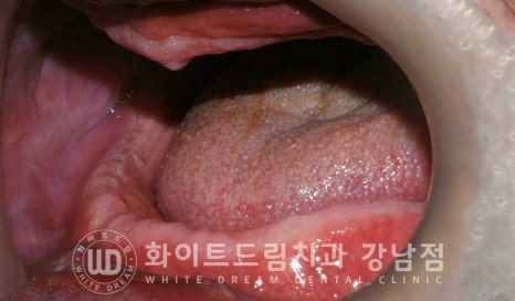 전체 임플란트 치료 기간과 수술 후 나타나는 변화는? 관련 이미지 6