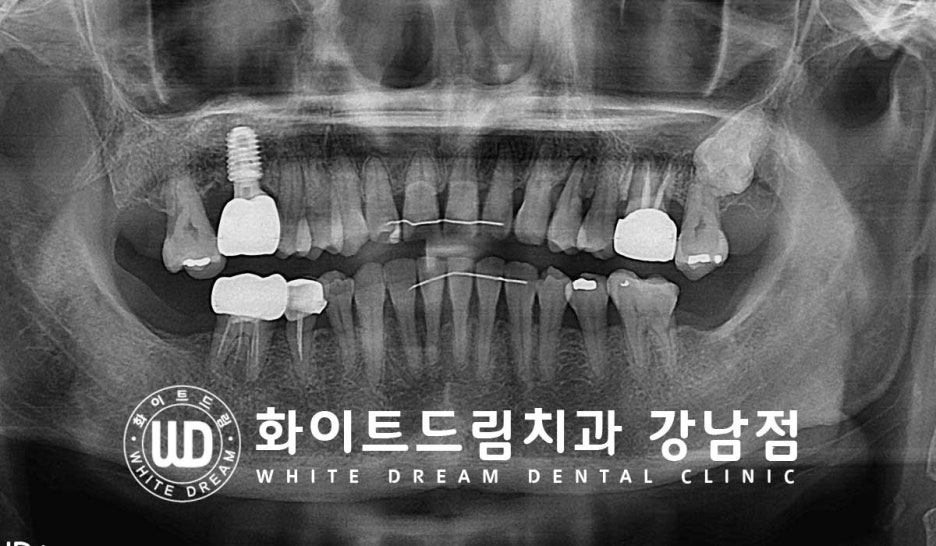 Why You Must Know About "Sinus Lift" Before Upper Molar Implants image 9