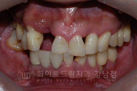 상악동거상술 잘하는치과, 강남역 화이트드림치과 상악동 함기화로 인한 거상술 치료 리뷰 관련 이미지 12