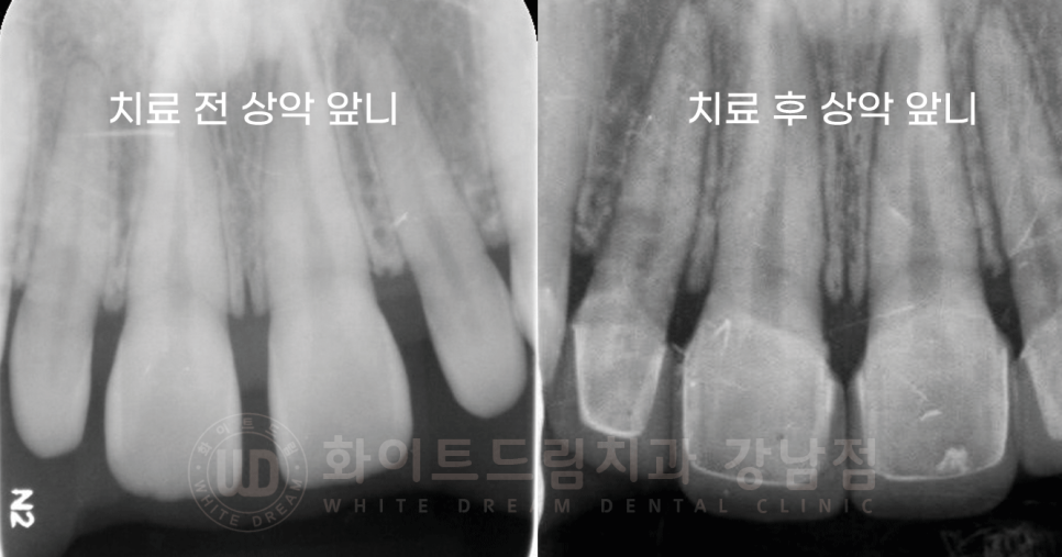 강남 벌어진앞니 교정 / "심하게 벌어진 치아, 어떻게?" 부분교정 + 라미네이트로 개선! 관련 이미지 11