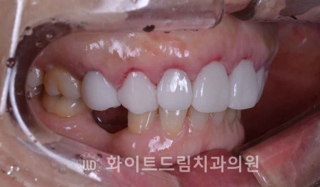 강남옹니라미네이트 "치아가 안으로 들어가서 할머니처럼 보여요" 경미 & 중증도 옹니 라미네이트 치료 관련 이미지 15