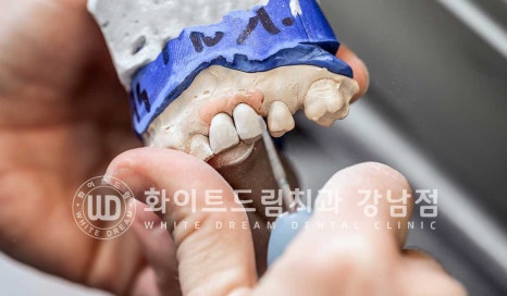 틀어진 치아 라미네이트, 틀어지고 색이 다른 앞니가 고민이에요. 관련 이미지 18