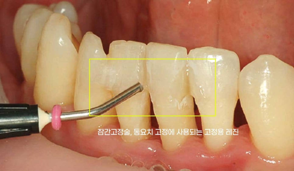 사고당한 앞니치료, "흔들리고 점점 변색돼요." 앞니 임플란트 & 신경치료 관련 이미지 3
