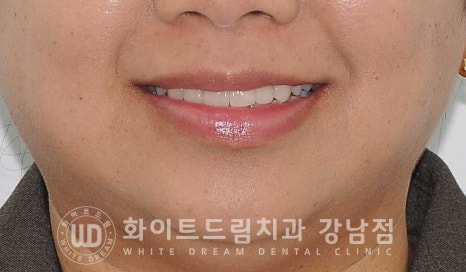 앞니 뻐드러짐 라미네이트 "뻐드러지고 벌어진 앞니" 당일 라미네이트 치료 case 관련 이미지 2