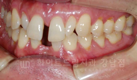 강남역 결손치 "앞니 두 개가 없고, 벌어졌어요" 결손치 치료 방법 관련 이미지 4